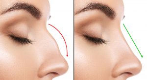 rhinoplastie de révision