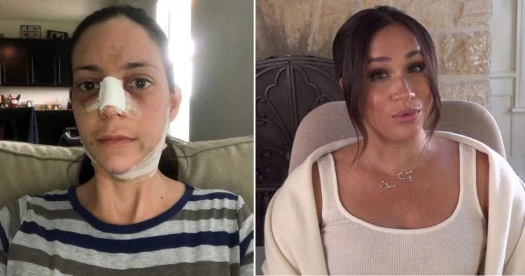 Cette femme dépense 28 000 euros en chirurgie esthétique pour ressembler à Meghan Markle, le résultat est SURPRENANT