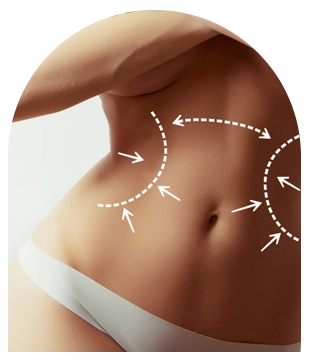 Abdominoplastie Turquie relâchement ventre