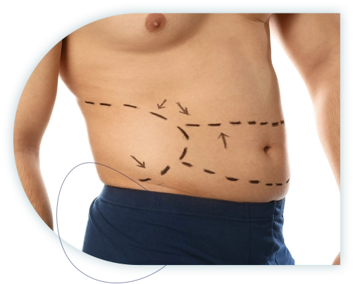 Quoi faire après une liposuccion ?