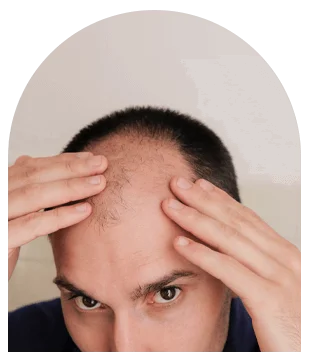 Greffe de cheveux en Tunisie