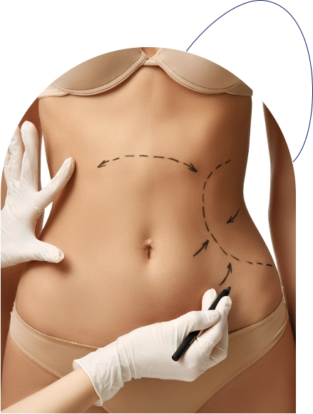 liposuccion ventre résultat au bout de combien de temps